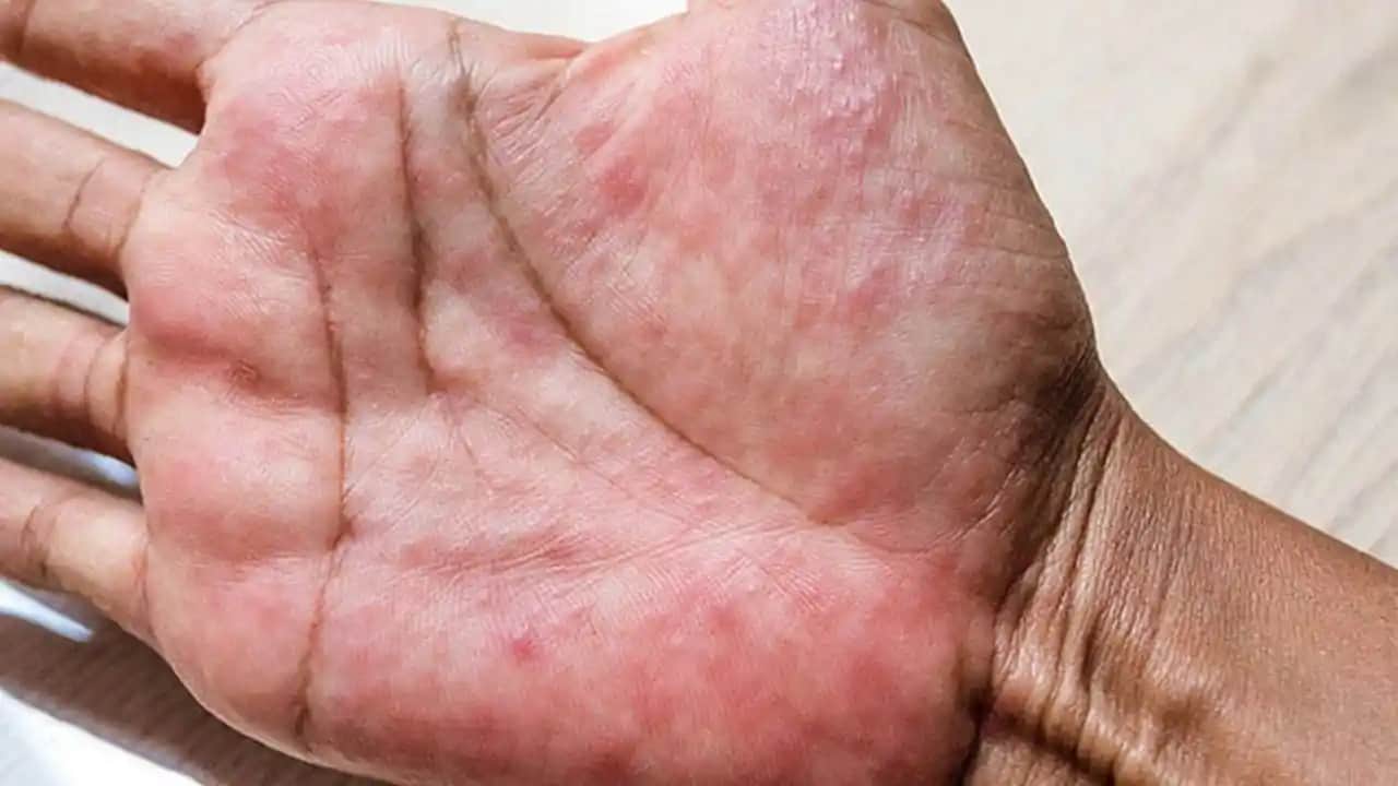 Egzama Nedir, Nedenleri ve Kozmetik Bakım İpuçları Hakkında Detaylı Bilgi