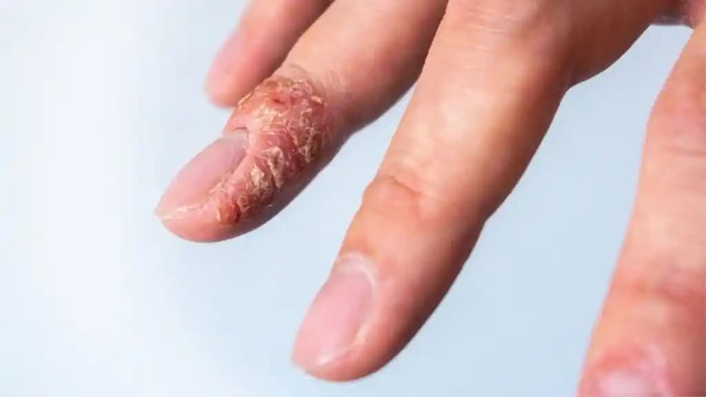 Egzama Parmak Arası: Belirtileri, Tedavisi ve Bakım İpuçları