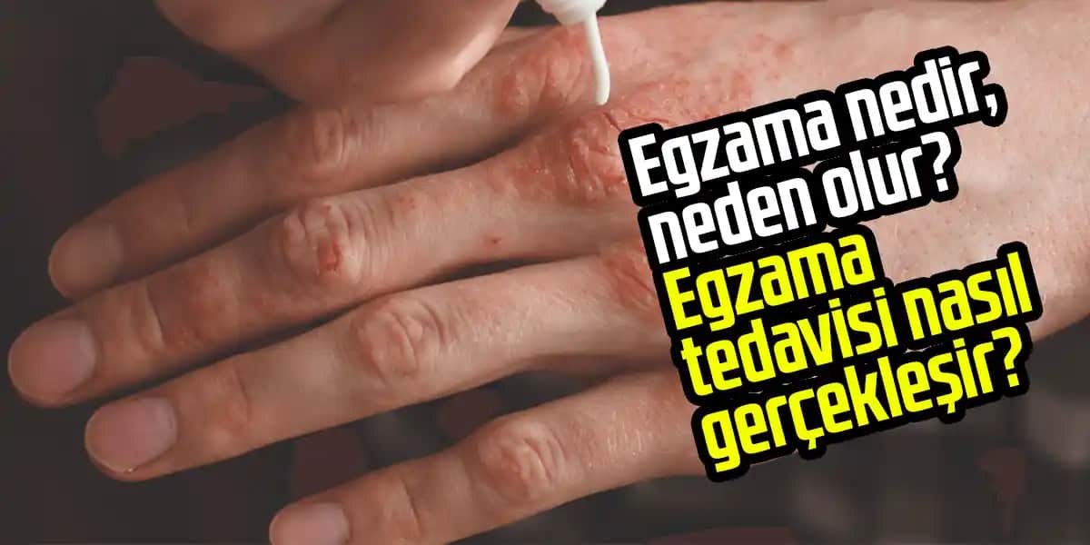 Egzama Tedavisi ve Yönetimi: Cilt Sağlığını Koruma Yöntemleri