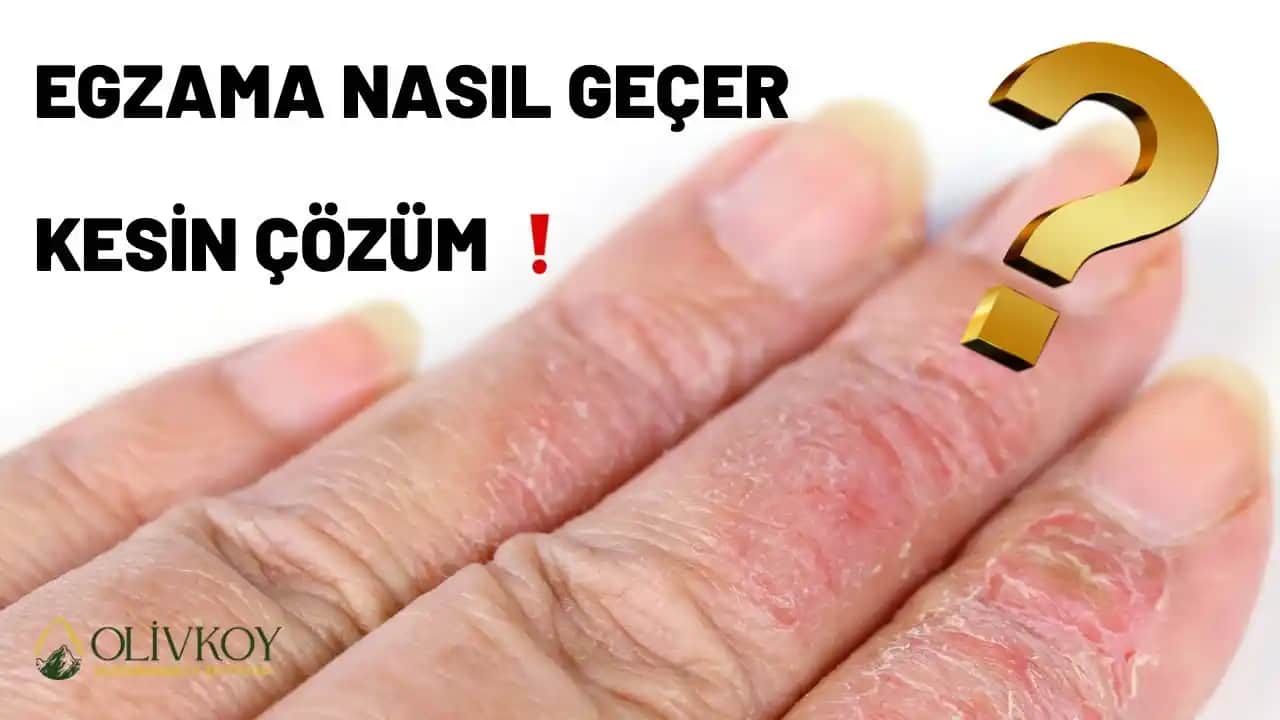 Egzama Tedavisinde Zeytinyağının Rolü ve Doğal Cilt Bakımı Yöntemleri