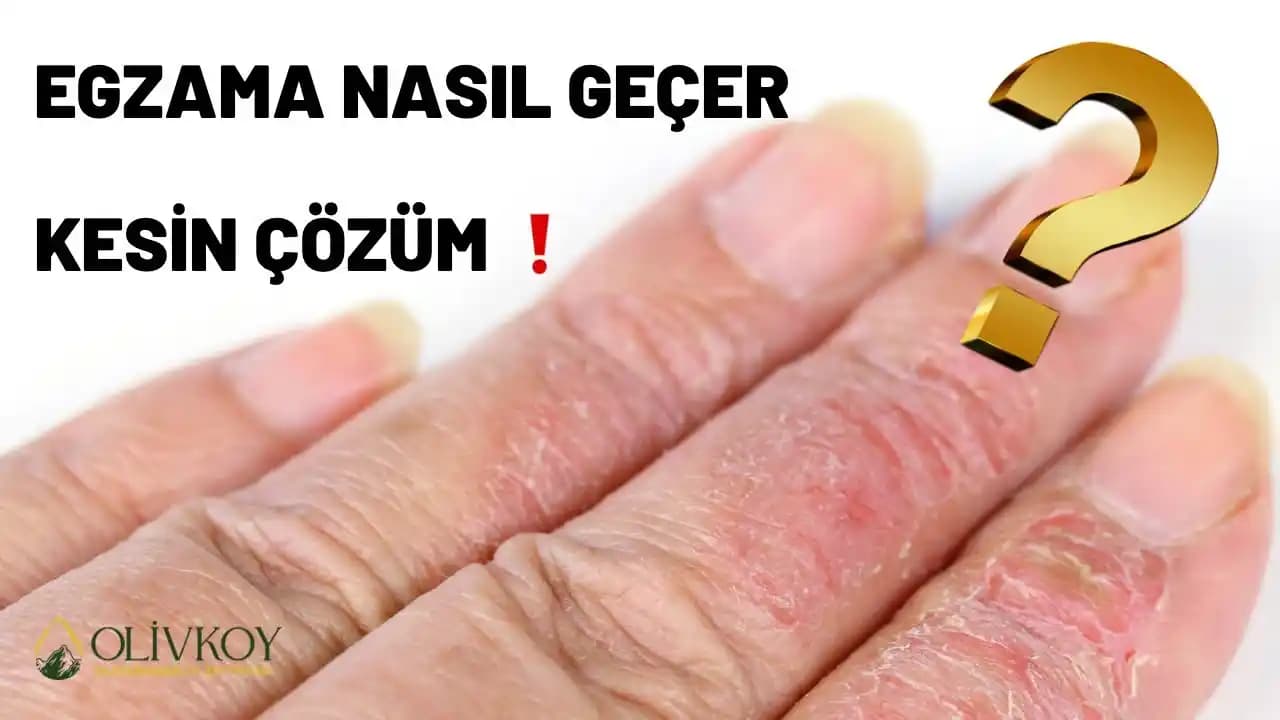 Egzama Tedavisinde Zeytinyağının Rolü ve Doğal Cilt Bakımı Yöntemleri