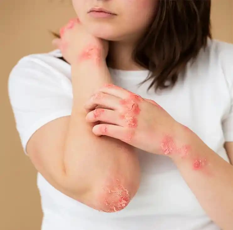 Egzama ve Cilt Sağlığı: Doğru Bakım Yöntemleri ve Bilinçli Yaklaşımlar