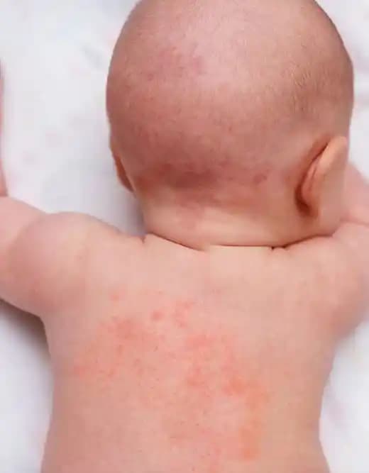 Egzama ve İğne Tedavisi: Güncel Yaklaşımlar ve Etkili Çözüm Yöntemleri