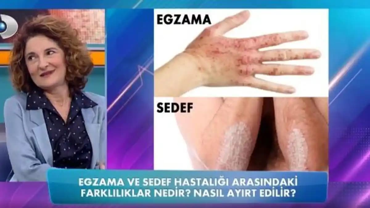 Egzama ve Sedef Hastalığı Arasındaki Farklar ve Cilt Sağlığına Etkileri