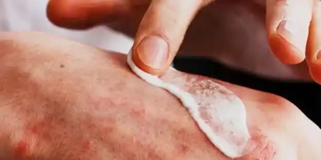 Egzama Yaraları ve Kozmetik Ürünlerle Yönetimi Hakkında Kapsamlı Bilgi