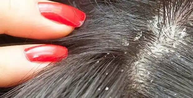 Egzamalı Saç Derisi için Doğal Çözüm ve Bakım İpuçları