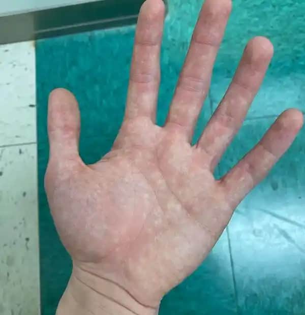 El Kızarıklığının Nedenleri ve Etkili Çözüm Yolları Hakkında Detaylı Bilgi