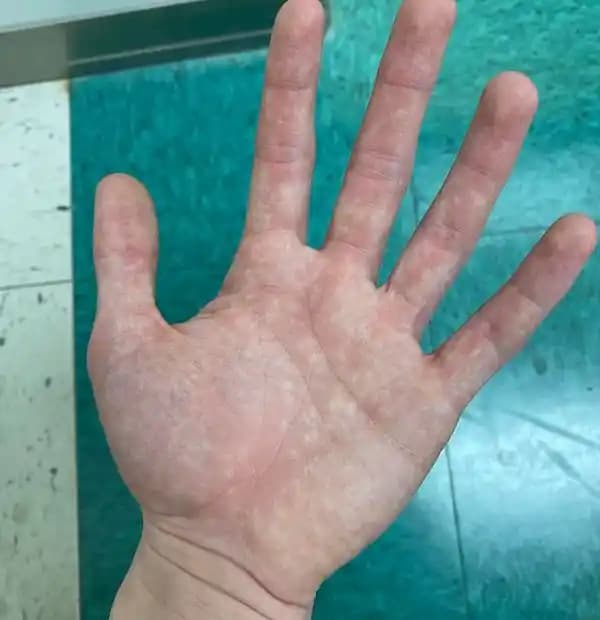 El Kızarıklığının Nedenleri ve Etkili Çözüm Yolları Hakkında Detaylı Bilgi