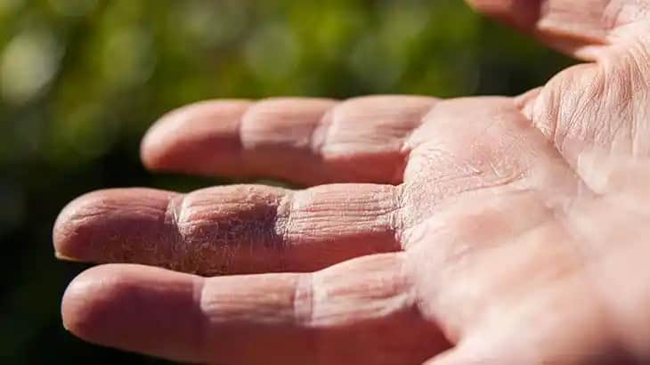 El Kuruluğu Nedenleri ve Cilt Sağlığını Koruma Yöntemleri