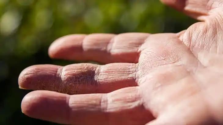 El Kuruluğu Nedenleri ve Cilt Sağlığını Koruma Yöntemleri