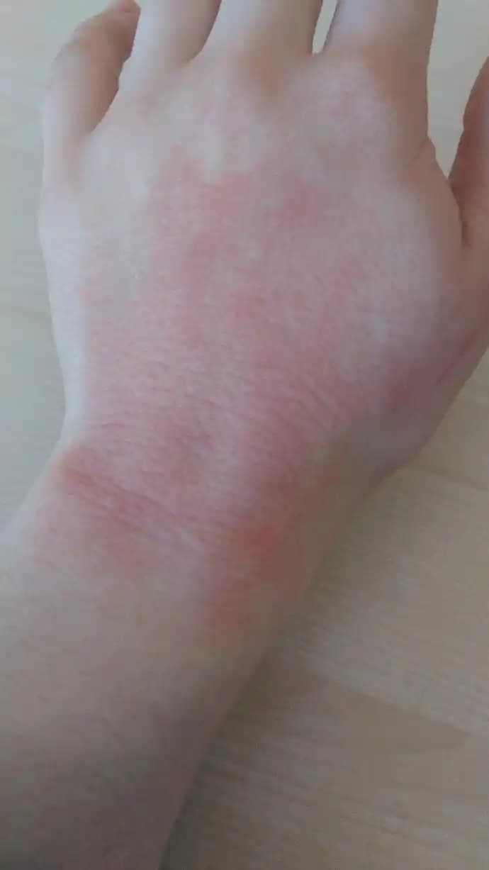 El Üstü Kızarıklıkları: Nedenleri, Kozmetik Yaklaşımlar ve Korunma Yolları