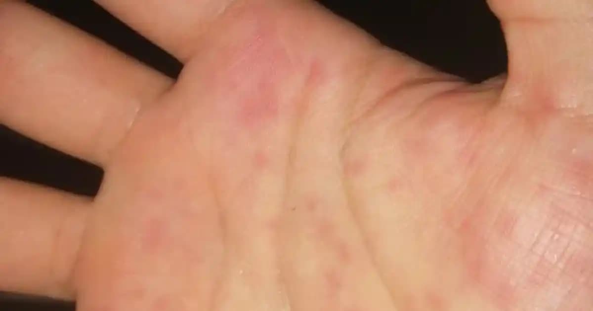 Elde Çıkan Kırmızı Noktanın Kozmetikteki Anlamı ve Çözüm Yolları Hakkında Detaylı Bilgi