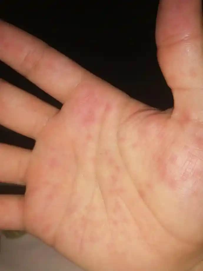 Elde Kırmızı Nokta Çıkmasının Nedenleri ve Etkili Çözüm Yöntemleri