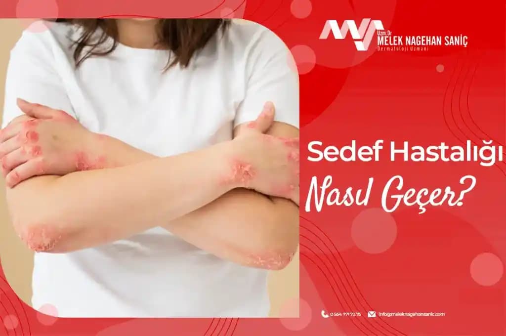 Elde Sedefi Nedir Nasıl Geçer, Belirtileri ve Doğal Tedavi Yöntemleri