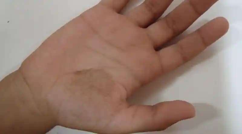 Elde Siyah Leke Nedenleri, Tedavi Yöntemleri ve Korunma İpuçları