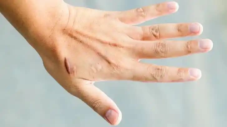 Eldeki yara izlerini azaltma yöntemleri ve estetik için dikkat edilmesi gerekenler