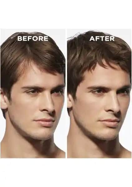 Erkekler İçin Saç Kalınlaştırıcı Yöntemler ve Doğal Alternatifler Hakkında Detaylı Bilgi