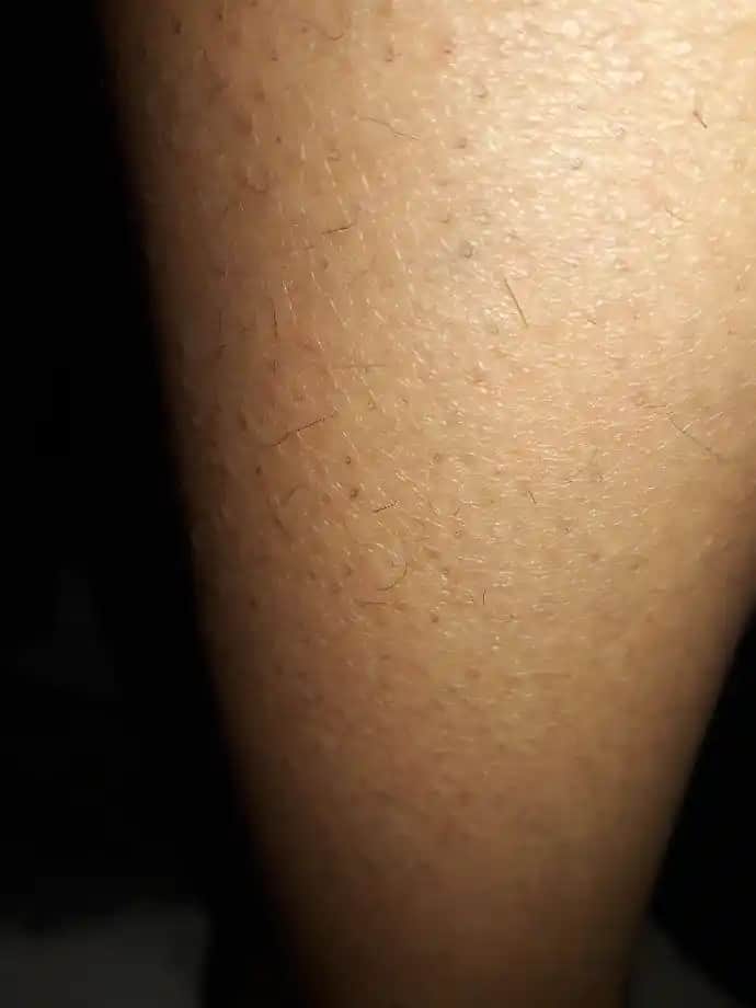 Erkeklerde Bacaklarda Kıl Dökülmesinin Nedenleri ve Etkili Çözüm Yolları