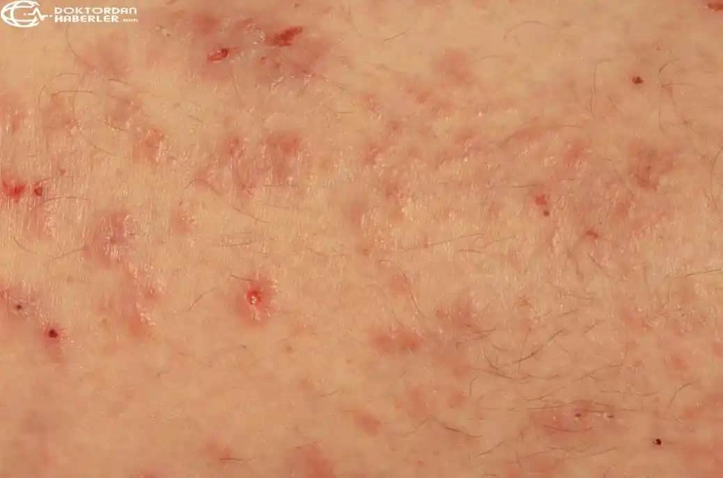 Erkeklerde Genital Bölgede Mantar Nedenleri, Belirtileri ve Korunma Yolları