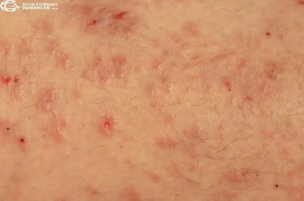 Erkeklerde Genital Bölgede Mantar Nedenleri, Belirtileri ve Korunma Yolları