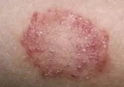 Erkeklerde Mantar Enfeksiyonu: Belirtiler, Tedavi ve Korunma Yöntemleri