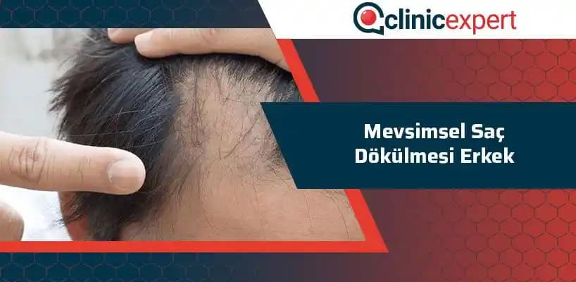 Erkeklerde Mevsimsel Saç Dökülmesi Nedenleri, Belirtileri ve Çözüm Yolları