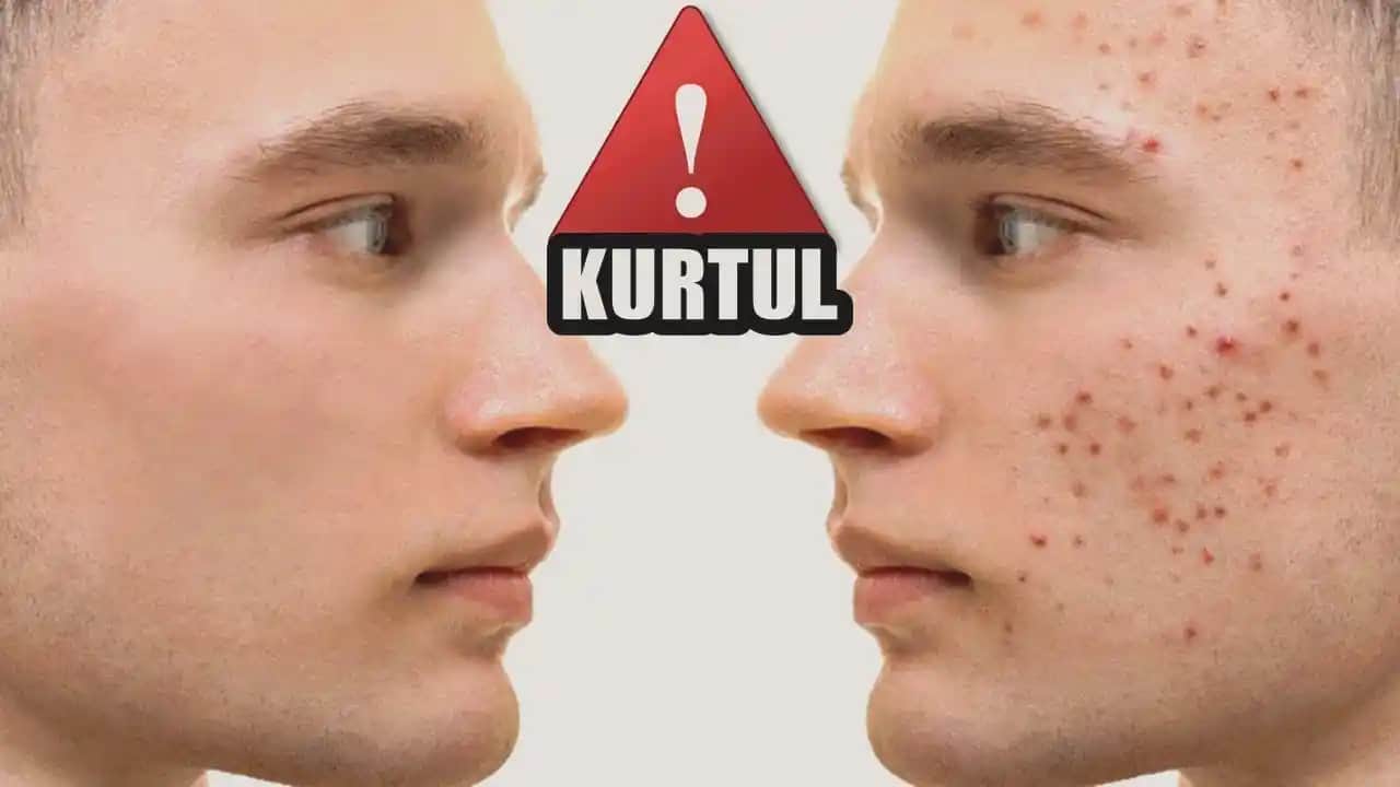 Erkeklerde Sivilcenin Ne Zaman Son Bulacağı ve Tedavi Süreçleri Hakkında Bilgiler