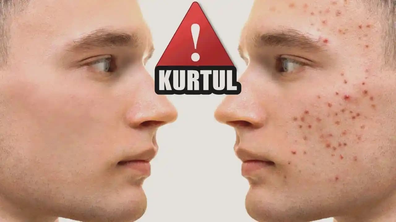 Erkeklerde Sivilcenin Ne Zaman Son Bulacağı ve Tedavi Süreçleri Hakkında Bilgiler