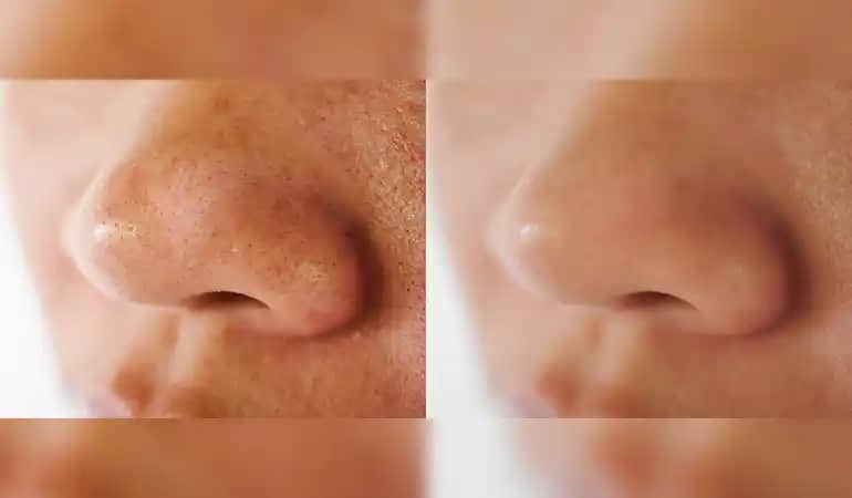 Evde Doğal Yöntemlerle Siyah Noktalarla Mücadele ve Cilt Temizliği Rehberi