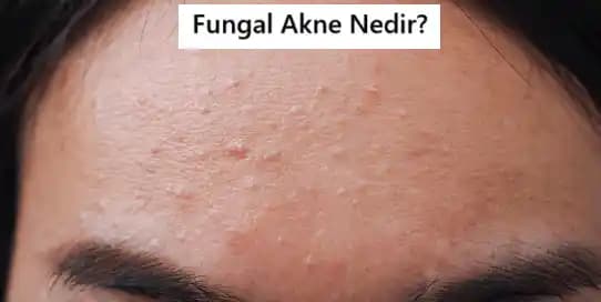Fungal Akne Nedir, Belirtileri ve Etkili Tedavi Yöntemleri Hakkında Detaylı Bilgi