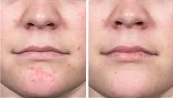 Geçmeyen Kistik Sivilceler: Nedenleri, Tedavi Yöntemleri ve Kozmetik Çözümler