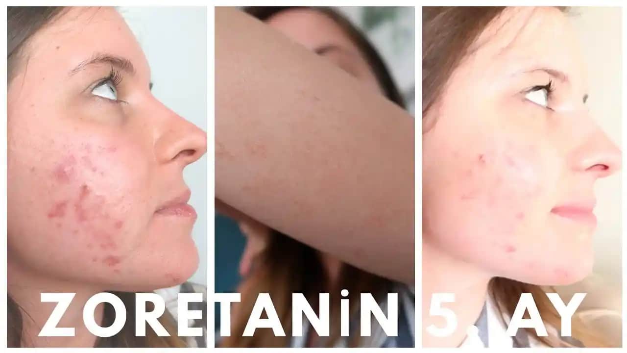 Geçmeyen Sivilce Şişlikleri ve Etkili Tedavi Yöntemleri Hakkında Uzman Tavsiyeleri