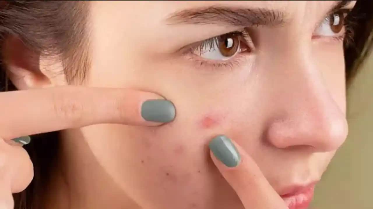 Geçmeyen Sivilcelerin Nedenleri ve Cilt Sağlığını Koruma Yöntemleri