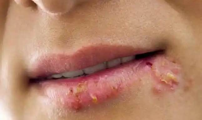 Geçmeyen Yaralar Nedenleri, Tedavi Yöntemleri ve Alınacak Önlemler