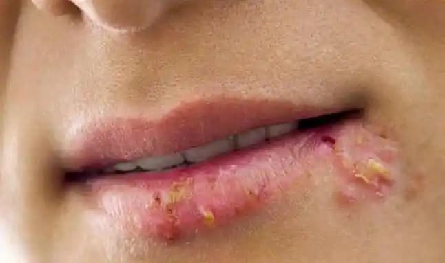 Geçmeyen Yaralar Nedenleri, Tedavi Yöntemleri ve Alınacak Önlemler