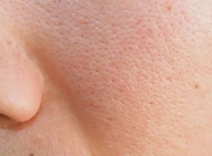 Geniş Gözenekler ve Doğal Yöntemlerle Cilt Sağlığını Koruma Rehberi