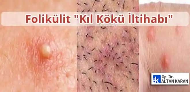 Genital Bölgedeki İltihaplı Batıkların Nedenleri, Belirtileri ve Etkili Tedavi Yöntemleri