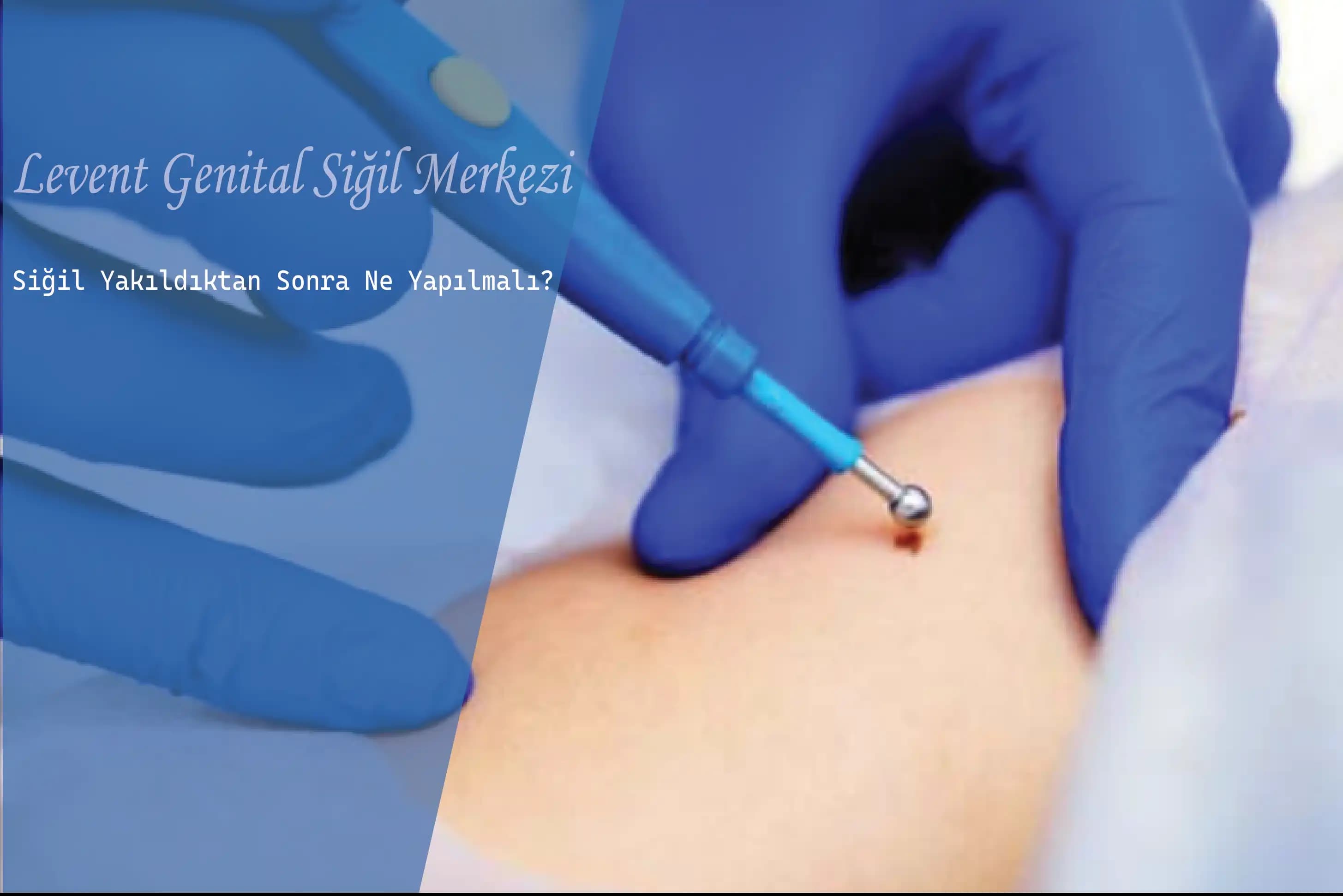 Genital Bölgedeki Kararmayı Anlamak ve Etkili Çözüm Yolları