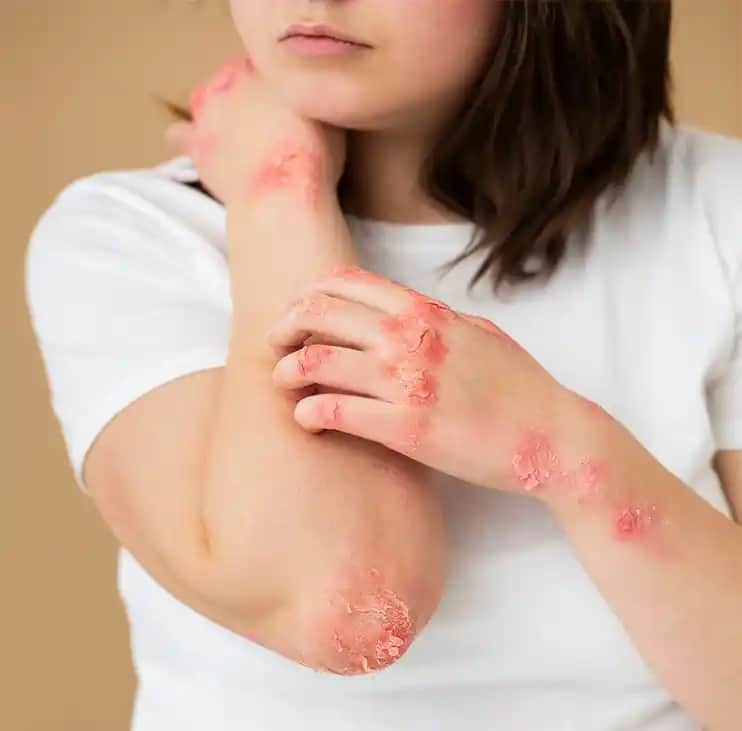 Göğüsler Arasında Egzama Nedenleri ve Etkili Bakım Yöntemleri Hakkında Bilgiler