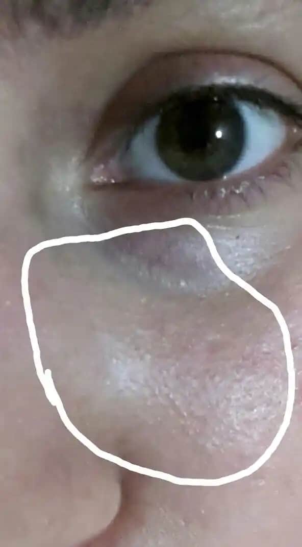 Göz Altı Beyaz Noktaları Nedenleri ve Etkili Bakım Yöntemleri Hakkında Bilgi