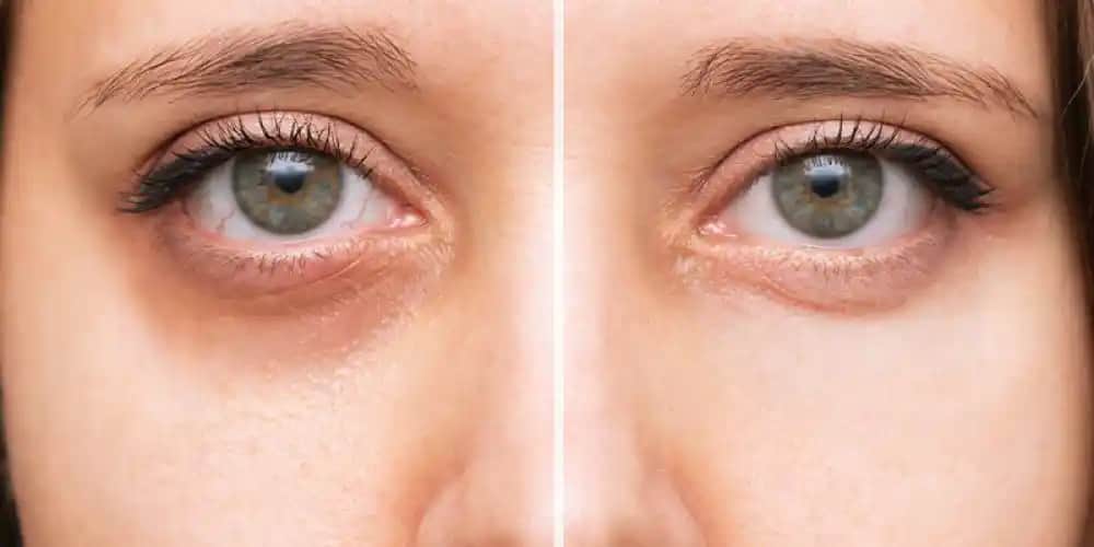 Göz Altı Çizgileri İçin Doğal ve Etkili Yöntemler ve Bakım Tavsiyeleri