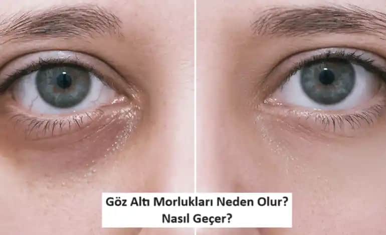 Göz Altı Halkalarının Nedenleri ve Etkili Çözüm Yolları Analizi