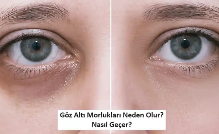 Göz Altı Halkalarının Nedenleri ve Etkili Çözüm Yolları Analizi