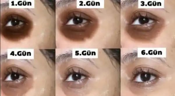 Göz Altı Kararması ve Vitamin Eksiklikleri: Nedenleri ve Çözüm Yolları