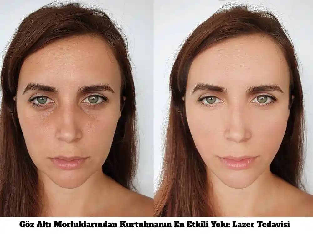 Göz Altı Morarması Nedenleri ve Etkili Çözüm Yöntemleri Hakkında Detaylı Bilgi