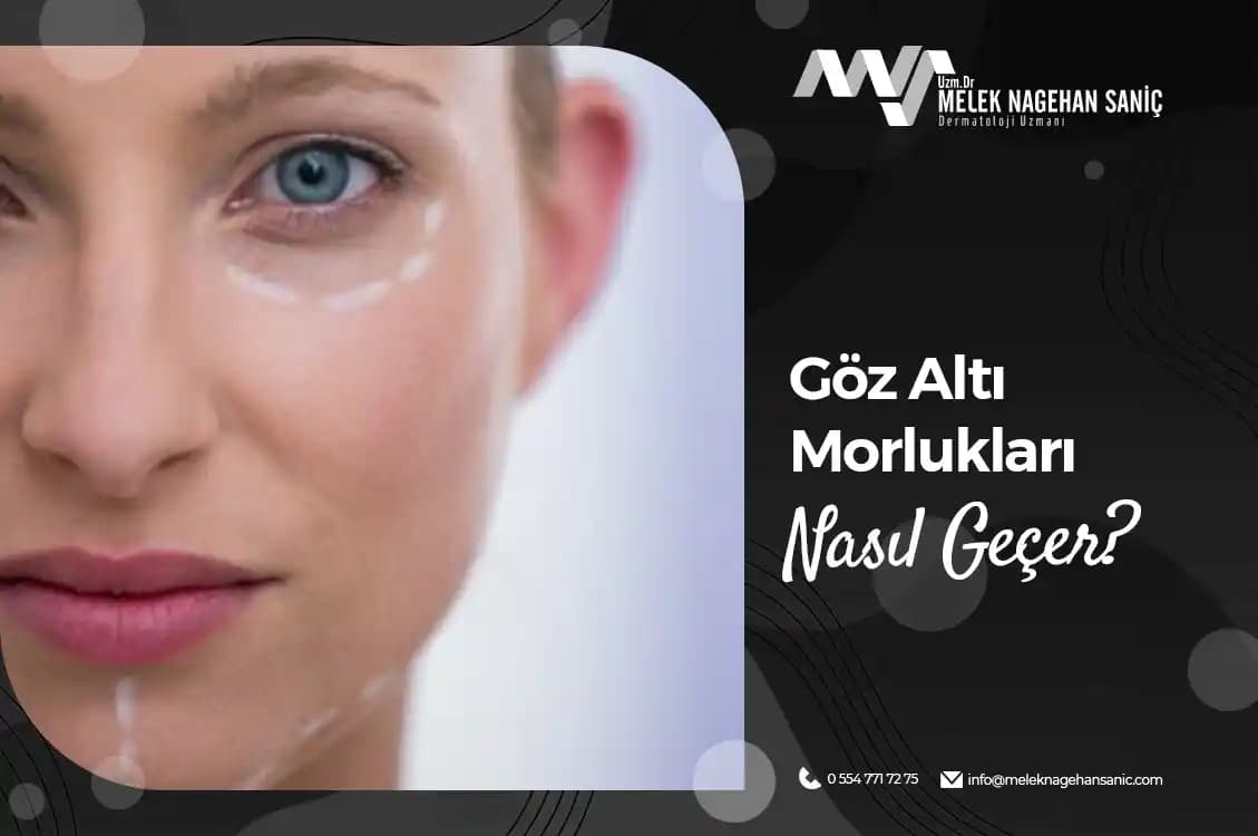 Göz Altı Morlukları Nasıl Geçer: Güncel ve Etkili Yöntemler Rehberi