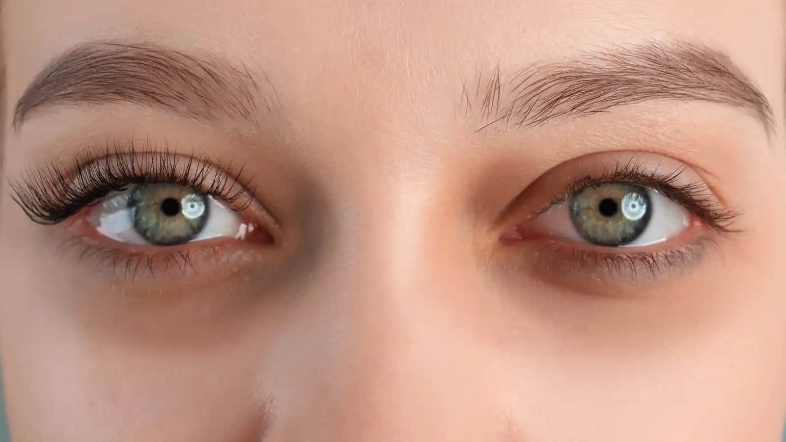 Göz Altı Morlukları Nasıl Giderilir: Etkili Doğal ve Medikal Çözüm Önerileri