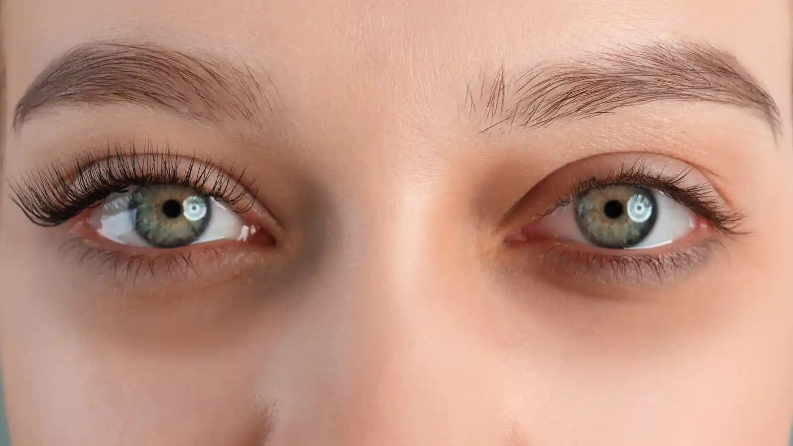 Göz Altı Morlukları Nasıl Giderilir: Etkili Doğal ve Medikal Çözüm Önerileri