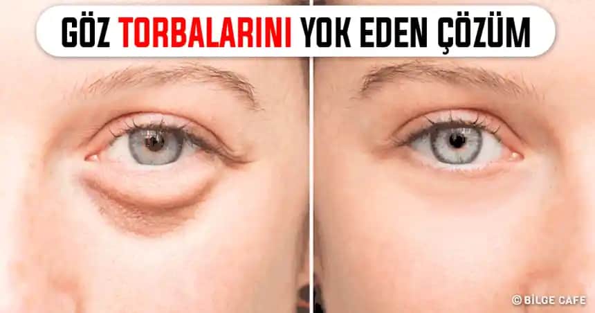 Göz Altı Morlukları ve Torbalarına Karşı Etkili Çözüm Yöntemleri ve Bakım İpuçları