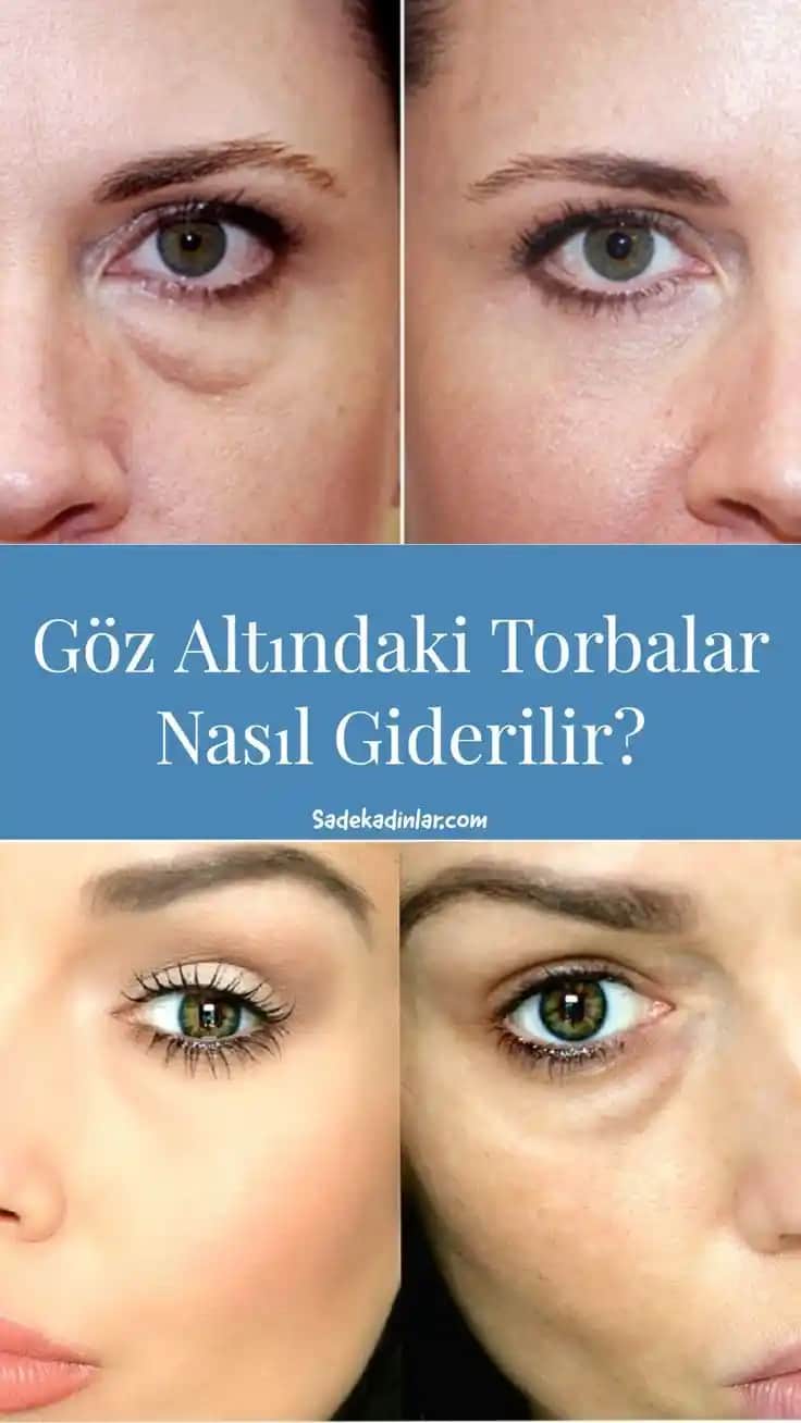 Göz Altı Morlukları ve Torbalarını Gidermenin Etkili Yöntemleri ve Uzman Tavsiyeleri